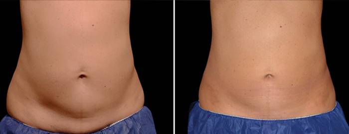 CoolSculpting Walnut Creek CA Before And After Photo CoolSculpting Walnut Creek CA Before And After Photo